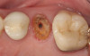 Figure 2  Same second bicuspid as Figure 1 after removal of the fractured fiber post.
