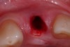 Figure 5  Initial site coring, occlusal view.