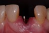 Figure 6  One-piece implant seated.