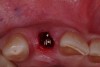 Figure 7  Occlusal view, facial bone defect.