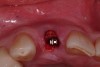 Figure 8  Occlusal view, grafted site.