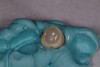 Figure 10  The natural tooth shell filled with regular composite.