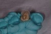 Figure 12  The provisional coping was registered in the natural tooth shell.