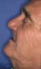 Figure 1  Figure 1 Extensive resorption of the maxilla caused by tooth loss results in a lack of adequate horizontal support of the orofacial soft tissues in a male patient.