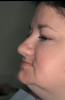 Figure 2  Ongoing loss of maxillary and mandibular basal bone leads to decreased vertical dimension and height of face from overclosure in a female patient.
