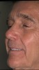 Figure 3  The patient seen in Figure 1 after placement of a maxillary overdenture. Note the return of facial esthetics through support of the soft tissues.