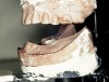 Figure 4  Excessive interarch space caused by advanced bone loss is evaluated through articulation before ideal esthetic and functional setup of the denture teeth.