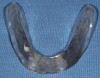 Figure 5A  A clear surgical guide fabricated by duplicating the ideal setup ensures implant placement within the confines of the final denture base.