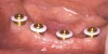 Figure 7C  Block-out rings were placed to prevent material from flowing into undercuts. Special attention must be given to block out any additional undercut areas to prevent 