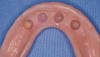Figure 7E  The final prosthesis was prepared for incorporation of the housings.