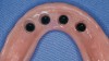 Figure 7G  Housings with black processing males, which were tacked in place with acrylic by means of the patient maintaining a medium biting force in centric occlusion while the material cured.