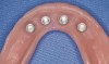 Figure 7H  Any voids around the housings were filled in extraorally, and black processing males were replaced by final retentive inserts (available in various amounts of retention).