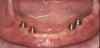 Figure 8  Distal implant placement resulted in a long unsupported span. A more ideal placement could be realized by increasing the interimplant spacing through the placement of the mesial implants closer to the midline