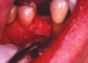 Figure 2c  The socket was grafted using a combination of freeze-dried bone allograft and a calcium sulfate bone graft barrier.