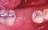Figure 3b  The socket was grafted using freeze-dried bone allograft mixed with CAPSET. The socket was allowed to heal for 4 months.