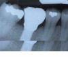 Figure 3d  The implant was placed uneventfully and was successfully restored after a 3-month healing period.