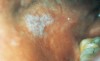 Figure 2  White plaque on right buccal mucosa (Case 8).
