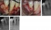 Figure 6  Clinical case from pivotal clinical trial treated with rhPDGF-BB in combination with ß-TCP. Upon flap reflection and debridement, a 2-wall intrabony defect was present (6A). At 9 months after treatment, surgical reentry showed excellent bone fill (6B). Radiographically, good defect resolution was achieved from baseline (6C) to 12 months (6D). This fill remained stable and had normal bone remodeling up to 36 months (6E).