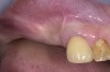 Figure 1  Buccal and radiographic views of posterior edentulism with significant sinus pneumatization in the molar region.
