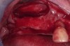 Figure 4  Lateral wall osteotomy.