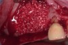 Figure 5  The osteotomy was grafted with particulate bone.