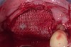 Figure 6  The surgical site was covered with a resorbable barrier.