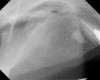 Figure 7  Radiographic confirmation of bone regeneration 8 months after surgery.