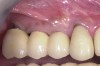 Figure 9  Final implant-supported restoration.