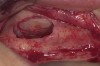 Figure 10  Antrostomy performed using piezoelectric surgery, leaving an intact sinus membrane.
