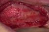 Figure 11  Particulate bone graft was placed to lift sinus floor.