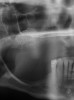 Figure 12  Radiographic confirmation of graft localization to the desired site before membrane application and wound closure.