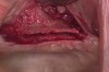 Figure 13  Ridge-split osteotomy with lateral wall expansion.