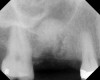 Figure 18  Radiographic confirmation of graft confinement and incremental addition.