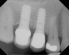 Figure 20  Radiographic confirmation of the re-establishment of the sinus floor.
