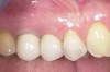 Figure 21  Final implant-supported restoration.
