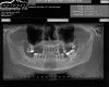 Figure 22  Sinus septum evident at site No. 3.