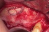 Figure 23  First, the sinus septum was identified.