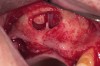 Figure 25  Lastly, the septum was managed.