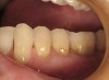 Figure 1  Class 5 restoration of abfractive lesions repaired with composite. Two years after treatment, two restorations are failing and one is missing.
