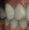 Figure 3  Fracture of porcelain veneer.
