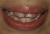 Figure 1  Heart transplant-associated gingival enlargement in a 16-year-old girl. Frontal view.