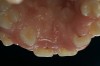 Figure 2  Heart transplant-associated gingival enlargement in a 16-year-old girl. Palatal view.