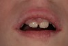 Figure 3  Chronic gingival enlargement of unknown origin in an 8-year-old girl.