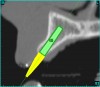 Figure 5a  The software (A) revealed a thinner facial-lingual crestal dimension, and (B) allowed a simulated bone graft to be placed.