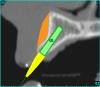 Figure 5b  The software (A) revealed a thinner facial-lingual crestal dimension, and (B) allowed a simulated bone graft to be placed.