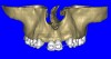 Figure 7a  The 3D reconstruction showed (A) the facial concavities and root eminences, and allowed (B) for evaluation of virtual implant placement to ensure the facial cortical plate was not perforated.