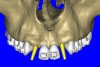 Figure 7b  The 3D reconstruction showed (A) the facial concavities and root eminences, and allowed (B) for evaluation of virtual implant placement to ensure the facial cortical plate was not perforated.