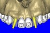 Figure 10b  By using the virtual teeth feature, (A) final implant and abutment positioning was checked, (B) the abutment projection evaluated for a cementable prosthesis, and (C) the appearance of the desired virtual restorations evaluated for emergence and esthetics.